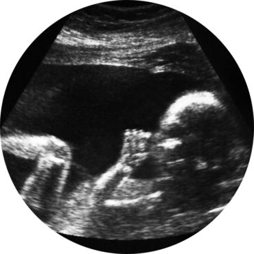 ultrasound of baby thumb-sucking